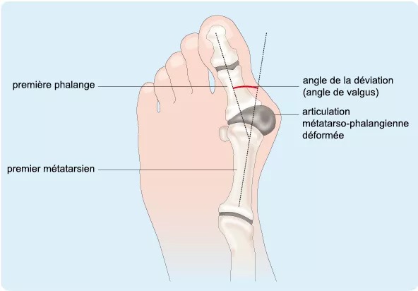 Illustration de l'Hallux Valgus 